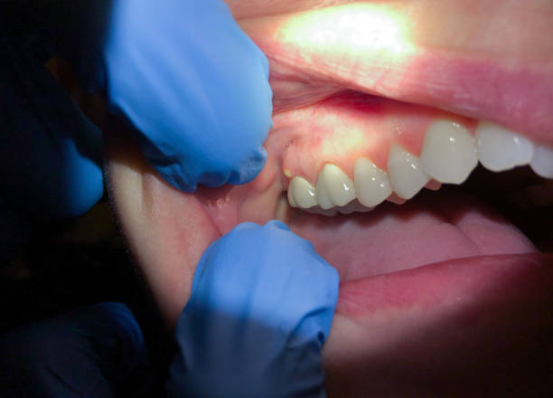 Best Emergency Dentist for Lost Fillings or Crowns in Heathcote, NJ